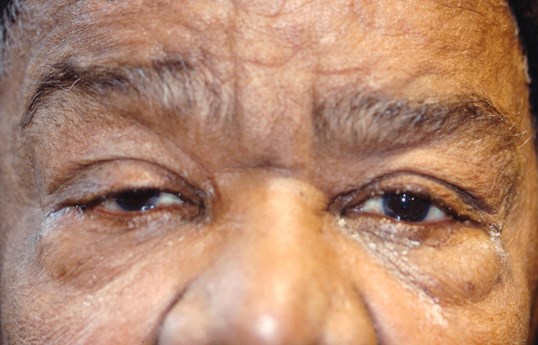 both eyes of female patient before ptosis repair treatment