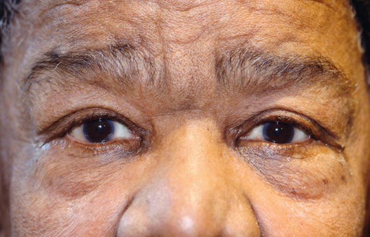 female close up patients eyes after ptosis repair