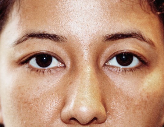 female patients eyes after ptosis repair by dr. James Gordon
