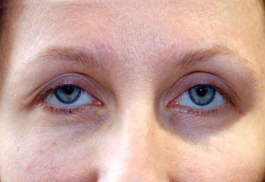 close up of both female eyes before ptosis treatment