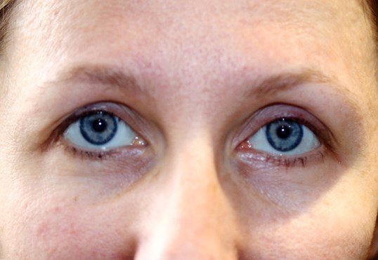 female patient eyes close up after ptosis repair