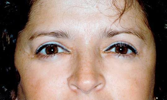 young woman after receiving a blepharoplasty