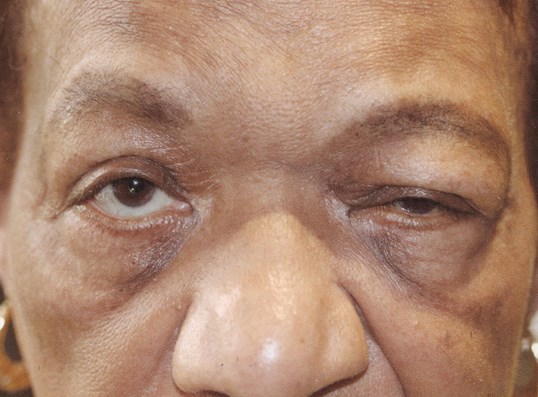 older man before receiving a blepharoplasty