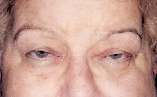 male patient before blepharoplasty by dr. James R. Gordon