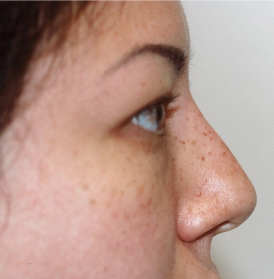 side profile of woman undergoing juvederm