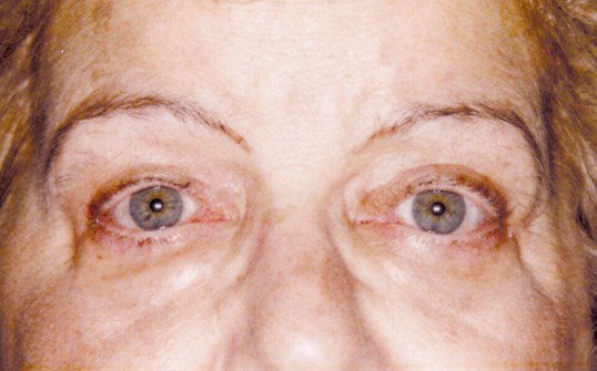 male patient with wide open eyes after blepharoplasty by dr. James R. Gordon