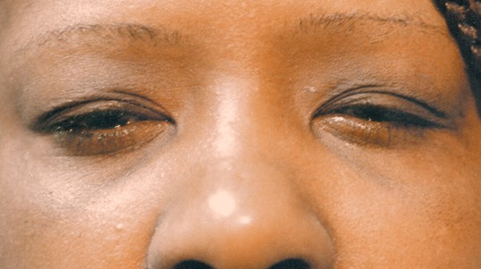 female patient with scrunched looking eyes before blepharoplasty with dr. Gordon
