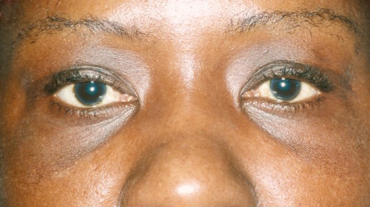 womans eyes looking forward blepharoplasty results