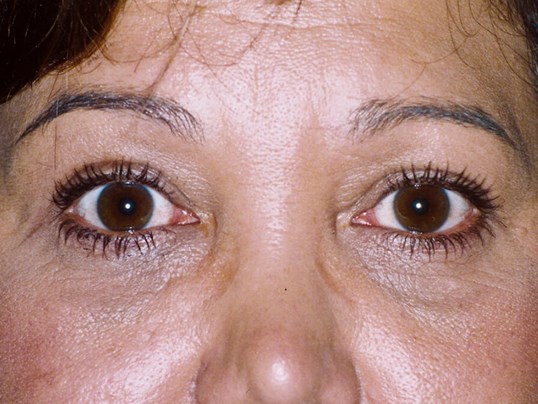 Brow lift on female patient at sightmd
