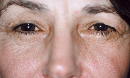 Brow lift procedure from Dr. James R Gordon