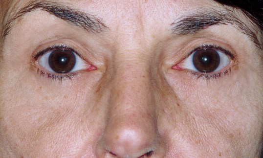 close up of patients eyes after brow lift procedure