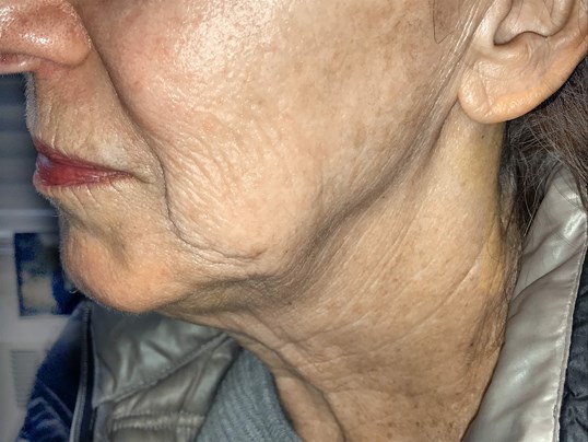 patient with sagging cheeks before mini facelift procedure