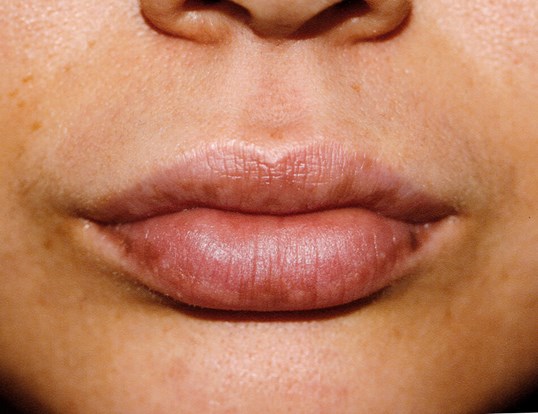 lip filler treatment after procedure using juvederm