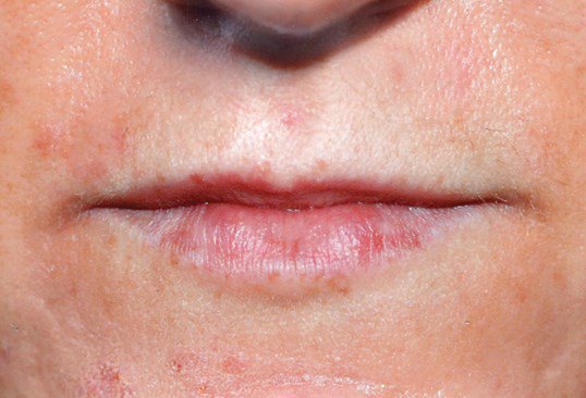 womans lips before juvederm treatment injections