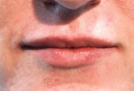 front profile of womans lips for juvederm treatment