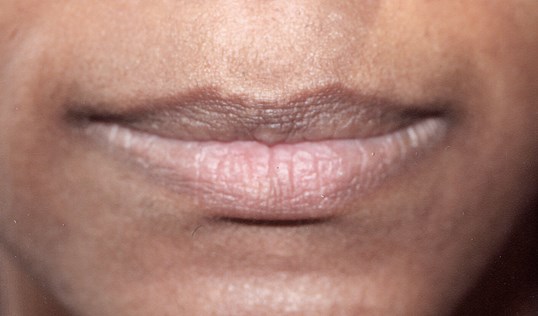 womans lips before juvederm injectable treatment