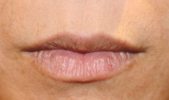 lips before receiving juvederm injectables