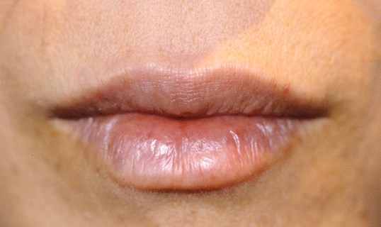 womans lips before and after juvederm treatment