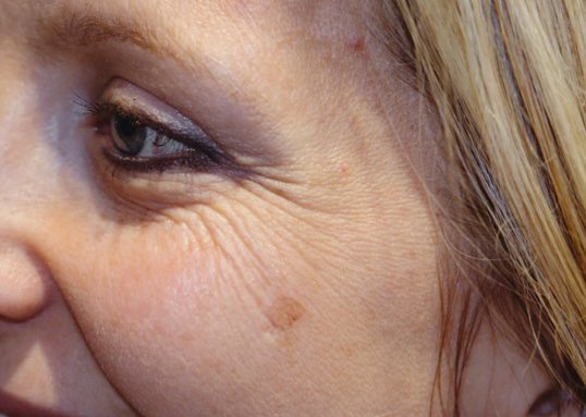 womans face before botox injections treatment