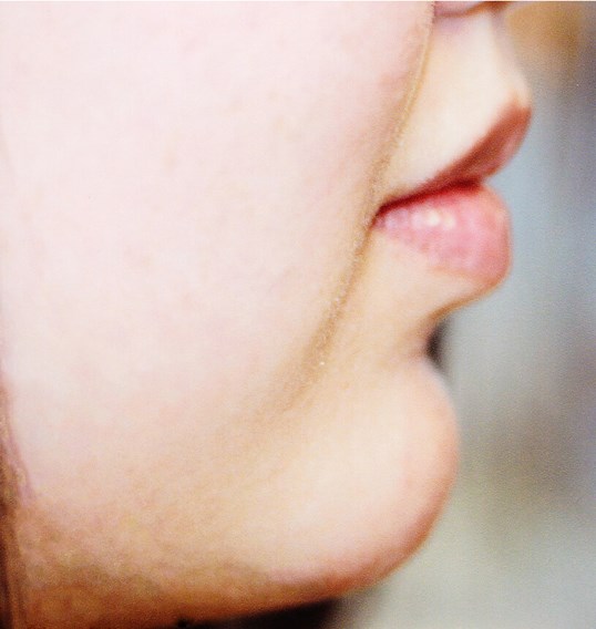 womans lips side profile before juvederm injectable treatment