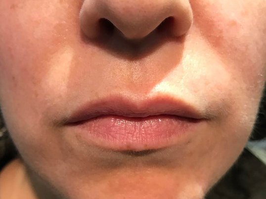 womans lips front profile before and after juvederm injectables