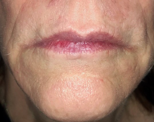lips of older woman after restylane injections