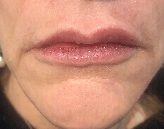 womans lips after restylane treatment looking more full