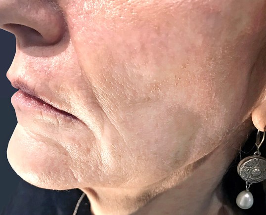 restylane injections to the lips on older patient