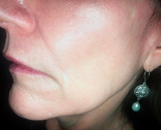 womans lips before restylane treatment from the side