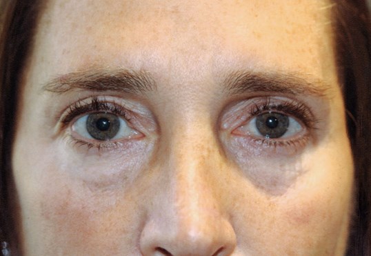 restylane results of the upper face on middle aged female patient