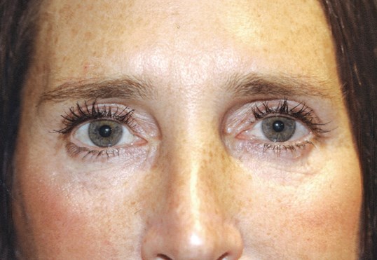 woman upper face after restylane treatment