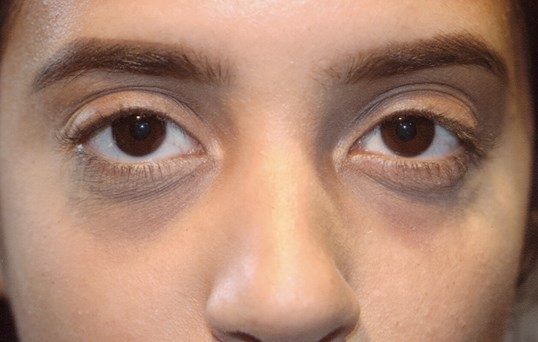 young female patient upper face restylane treatment results