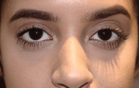 woman upper face looking straight ahead following restylane treatment
