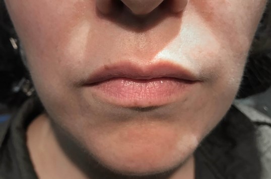 young womans lips after restylane injections