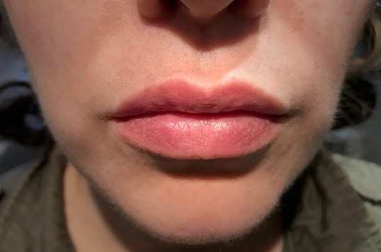 womans lips looking more full after restylane injections