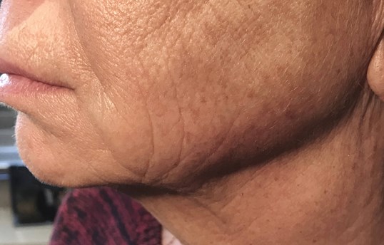 side view of womans lips restylane before and after