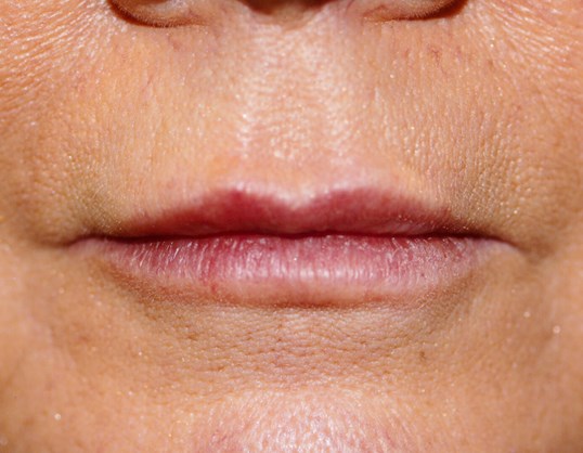 womans lips before restylane treatment