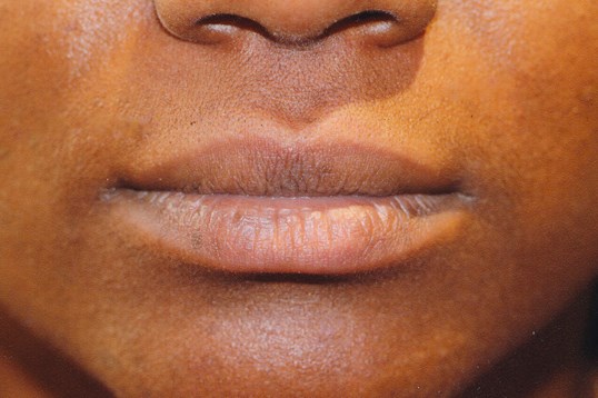 restylane injectable treatment before proceudre