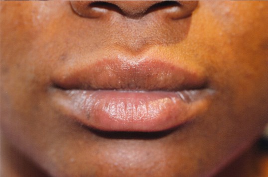 womans lips after restylane injectables