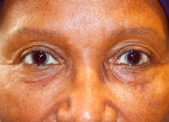 upper face of a middle aged woman after restylane treatment