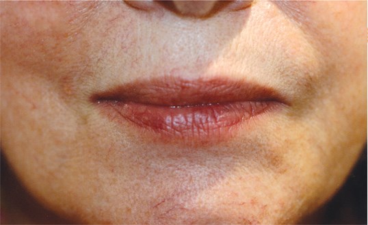 full looking lips following a restylane procedure