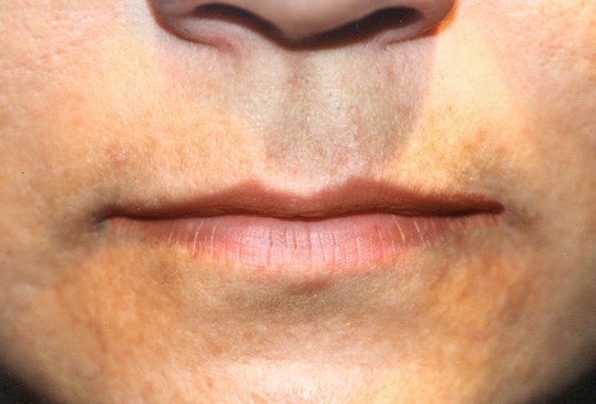female patient before restylane injectable treatments