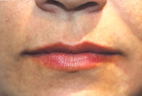 womans full looking lips from restylane injectable treatment