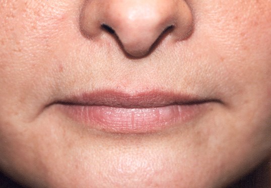 female lips before injectables procedure of restylane to the lips