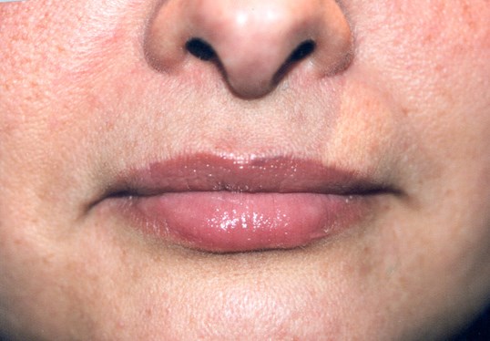 lips on a woman from restylane
