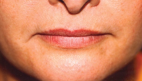 before restylane injectable procedure on female lips