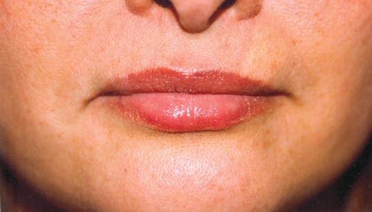restylane injectable treatment after photo