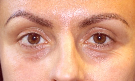 middle of a womans face restylane treatment
