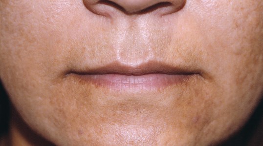 before and after of woman receiving restylane