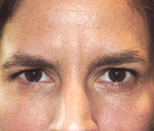 womans forehead before botox injectable treatment